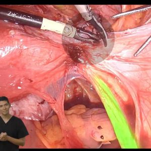 Histerectomía Laparoscópica - Curso Online